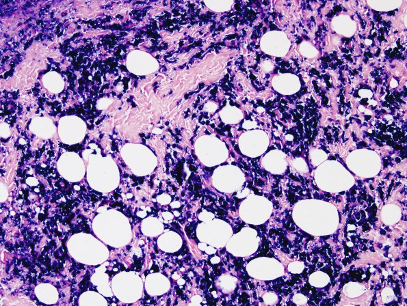 9D Plasma Cell Neoplasm (Case 9) ISH Kappa 2