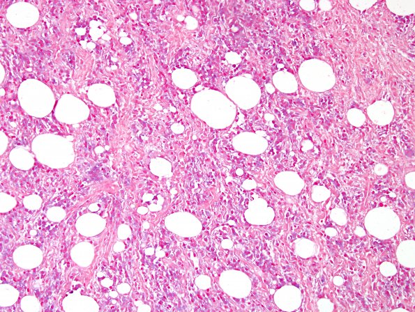 9E Plasma Cell Neoplasm (Case 9) ISH lambda