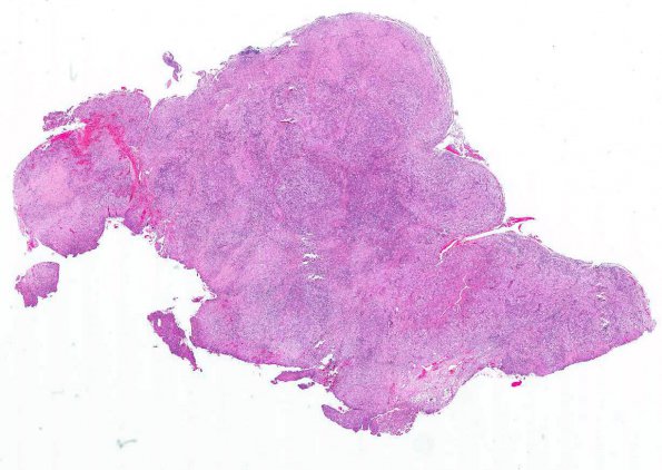 11A1 Rosai-Dorfman Disease (AANP 2002 Case 9) H&E WM