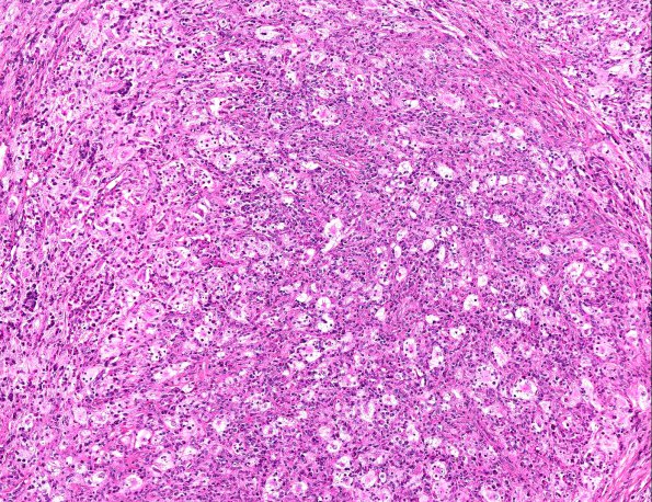 11A3 Rosai-Dorfman Disease (AANP 2002 Case 9) H&E 10X