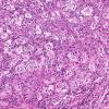 11A4 Rosai-Dorfman Disease (AANP 2002 Case 9) H&E 20X 2