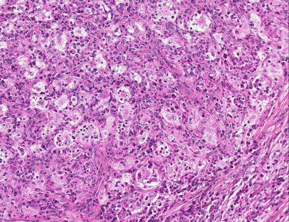 11A4 Rosai-Dorfman Disease (AANP 2002 Case 9) H&E 20X 2