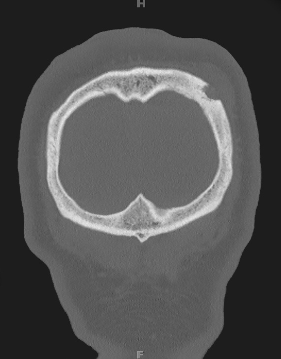 3A0 Rosai-Dorfman Dz (Case 3) Bone Stealth 1 - Copy