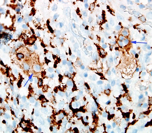 3B3 Rosai-Dorfman Dz (Case 3) CD163 3 copy.jpg