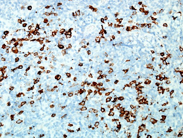 3E Rosai-Dorfman Dz (Case 3) CD138 1.jpg