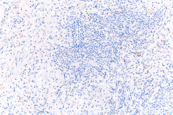 4C2 Rosai-Dorfman Dz (Case 4) FXIIIa 20X