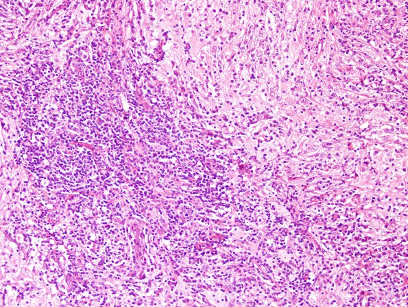 5A2 Rosai-Dorfman Dz (Case 5) H&E 2.jpg