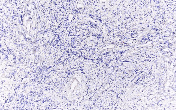 5C Rosai-Dorfman Dz (Case 5) CD1a 20X