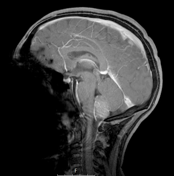 6A2 Rosai-Dorfman (Case 6) T1 fl2d with contrast - Copy