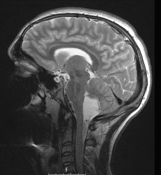 6A3 Rosai-Dorfman (Case 6) T2 W contrast - Copy