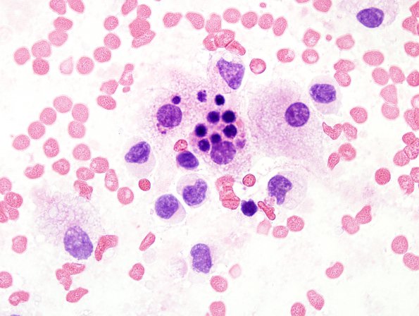 6B3 Rosai-Dorfman (Case 6)  Smear_5