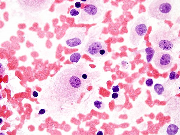 6B4 Rosai-Dorfman (Case 6) H&E smear 100X 1.jpg