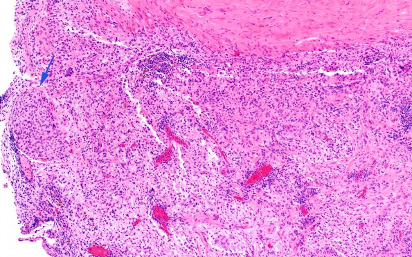 7A4 Rosai-Dorfman Dz & Meningeal Hyperplasia (Case 7) H&E 2A copy