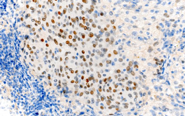 7A6 Rosai-Dorfman Dz & Meningeal Hyperplasia (Case 7) PR 40X