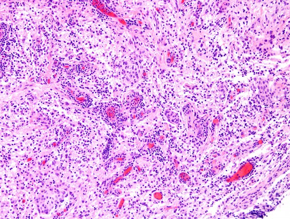 7A8 Rosai-Dorfman Dz & Meningeal Hyperplasia (Case 7) H&E 2.jpg