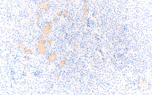 7C Rosai-Dorfman Dz & Meningeal Hyperplasia (Case 7) CD1a 20X