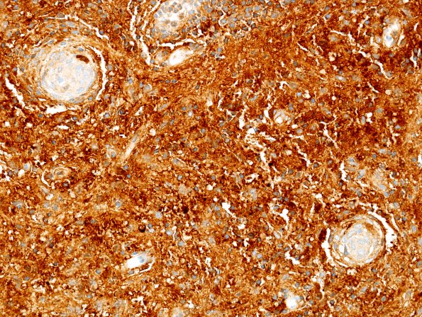 7E1 Rosai-Dorfman Dz & Meningeal Hyperplasia (Case 7) S100 1.jpg