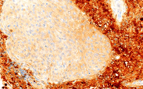 7E2 Rosai-Dorfman Dz & Meningeal Hyperplasia (Case 7) S100 40X 2