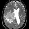 10A Meningioma, anaplastic (Case 10) T2 3 - Copy