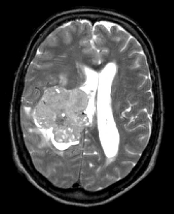 10A Meningioma, anaplastic (Case 10) T2 3 - Copy