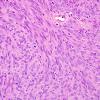 10B1 Meningioma, anaplastic (Case 10) H&E 2