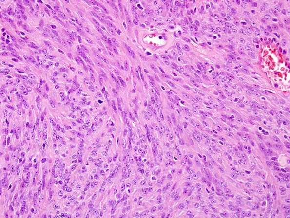 10B1 Meningioma, anaplastic (Case 10) H&E 2