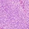 10B2 Meningioma, anaplastic (Case 10) H&E 5