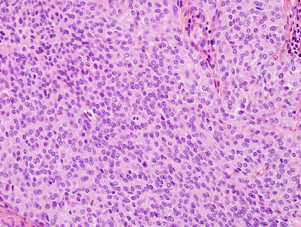 10B2 Meningioma, anaplastic (Case 10) H&E 5