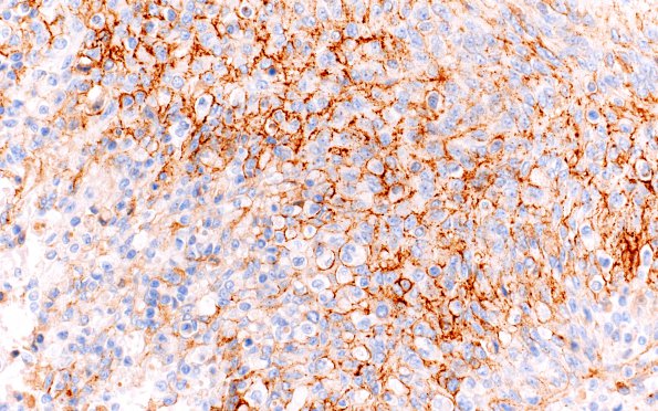 10C1 Meningioma, anaplastic (Case 10) EMA 2