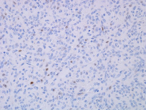 10C2 Meningioma, anaplastic (Case 10) PR