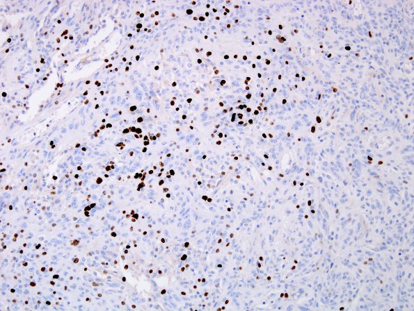 10D Meningioma, anaplastic (Case 10) MIB