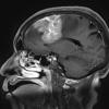 11A1 Meningioma, anaplastic (Case 11) T1W sagittal - Copy