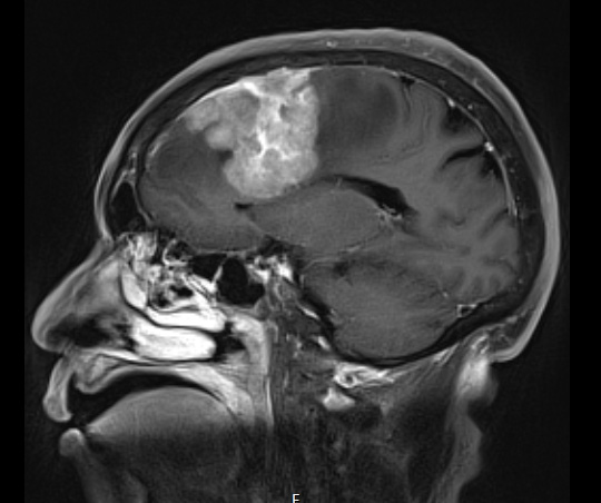 11A1 Meningioma, anaplastic (Case 11) T1W sagittal - Copy