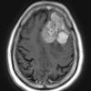 11A2 Meningioma, anaplastic (Case 11) T1W axial - Copy