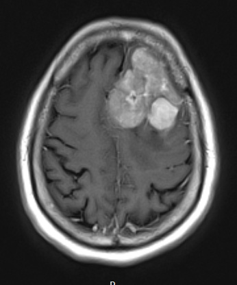 11A2 Meningioma, anaplastic (Case 11) T1W axial - Copy