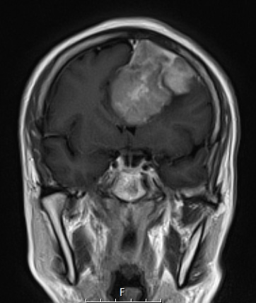 11A3 Meningioma, anaplastic (Case 11) T1W coronal - Copy