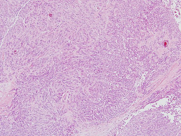 11B1 Meningioma, anaplastic (Case 11) H&E 2