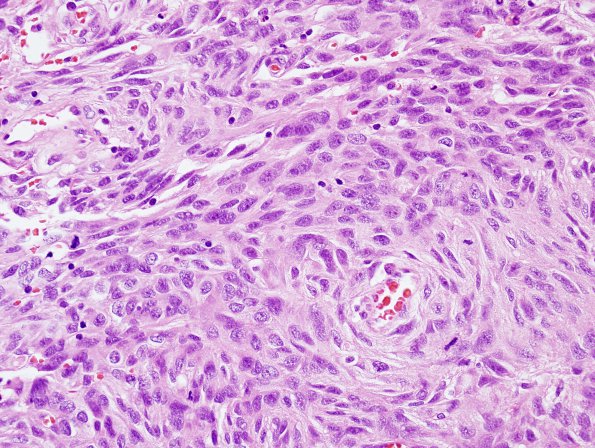 11B2 Meningioma, anaplastic (Case 11) H&E 7