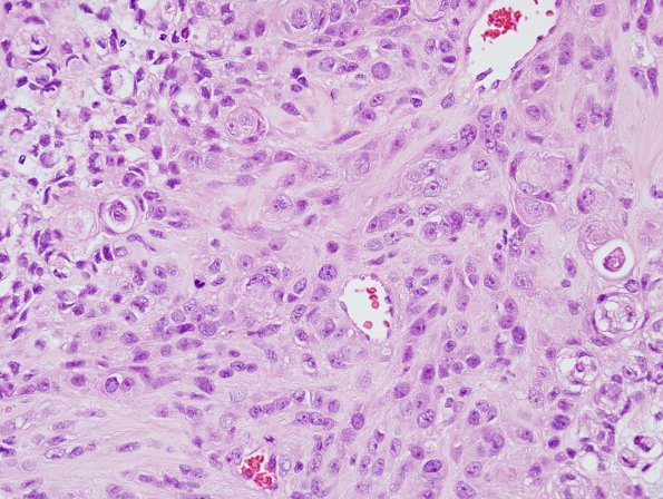 11B3 Meningioma, anaplastic (Case 11) H&E 16