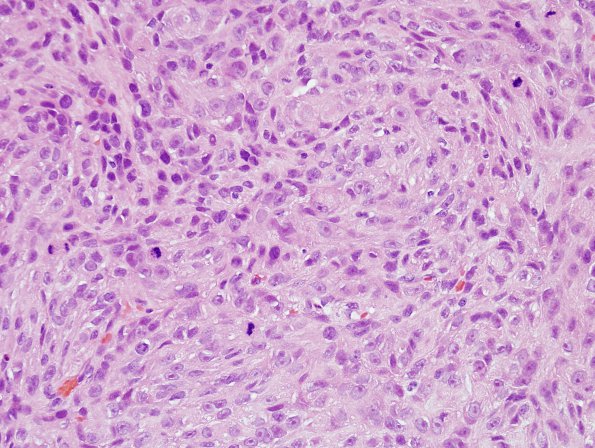 11B4 Meningioma, anaplastic (Case 11) H&E 4