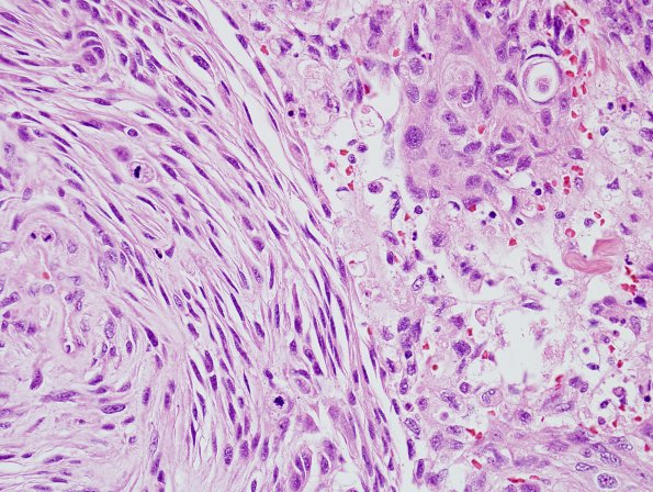 11B5 Meningioma, anaplastic (Case 11) H&E 12