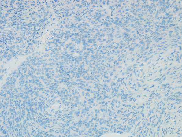 11C1 Meningioma, anaplastic (Case 11) EMA 1