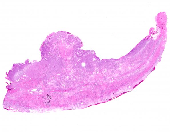 12A1 Meningioma, Anaplastic (Case 12) H&E WM