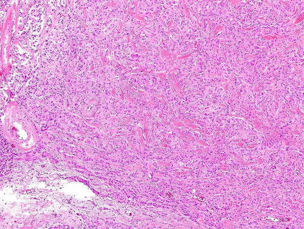 12A2 Meningioma, Anaplastic (Case 12) H&E 8