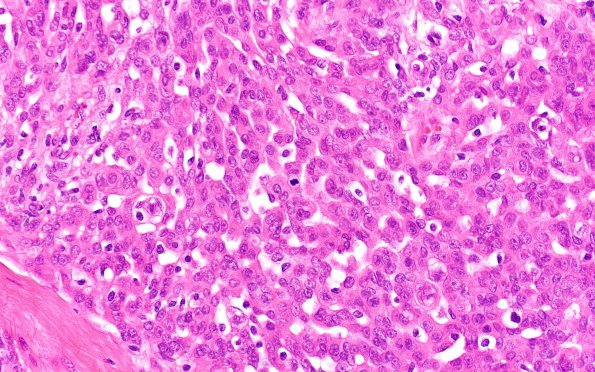 12A3 Meningioma, Anaplastic (Case 12) H&E 40x