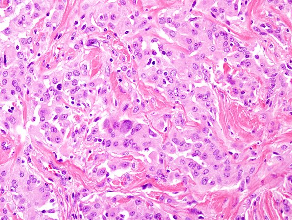 12A4 Meningioma, Anaplastic (Case 12) H&E 3