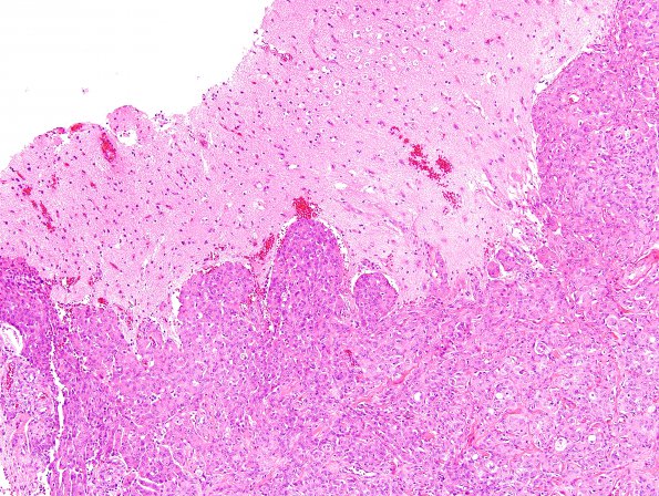 12A5 Meningioma, Anaplastic (Case 12) H&E 9