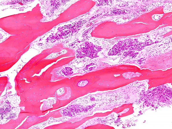 12A6 Meningioma, Anaplastic (Case 12) H&E 10