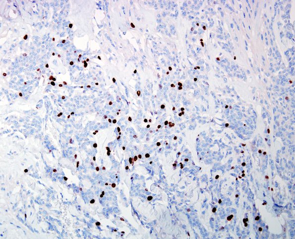 12B Meningioma, Anaplastic (Case 12) MIB1