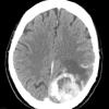 13A Meningioma, anaplastic (Case 13) CT 2 - Copy